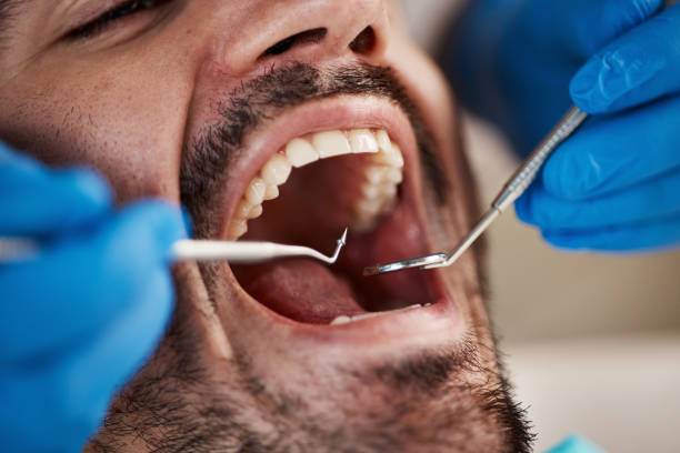 Best Emergency Treatment for Dental Infections or Abscesses in North Wildwood, NJ