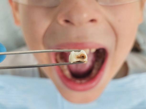 Best Emergency Dental Care for Broken or Chipped Teeth in North Wildwood, NJ
